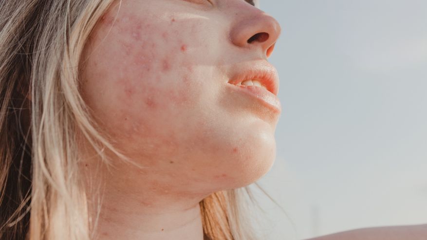 Acne, punti neri e foruncoli: i Fiori di Bach per una pelle sana e luminosa